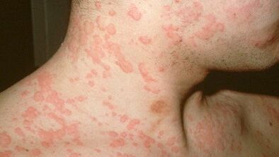 Welke parasieten in het lichaam kunnen allergieën veroorzaken